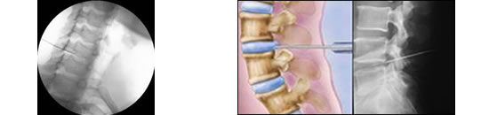 Discólisis Percutánea