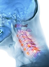 Canal Estrecho Cervical